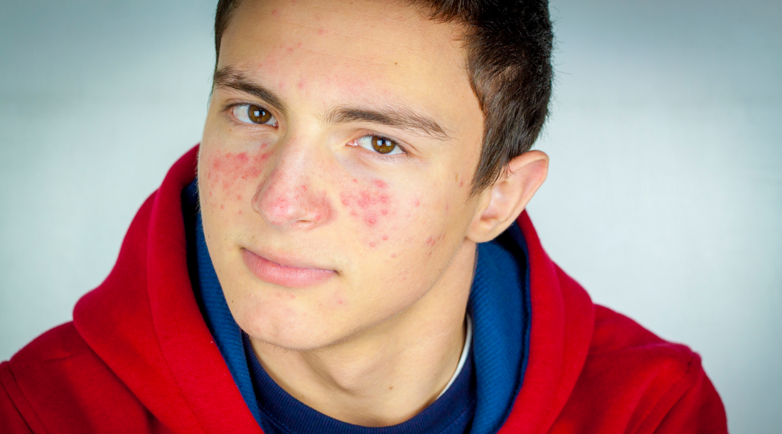 How To Tell If Your Skin Is Purging Or Just Breaking Out. Purging is a process where clogged pores (called microcomedones) lurking under the surface are forming at a faster rate to increase cell turnover.